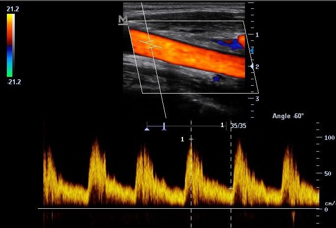Sonogram of carotid artery with waveform