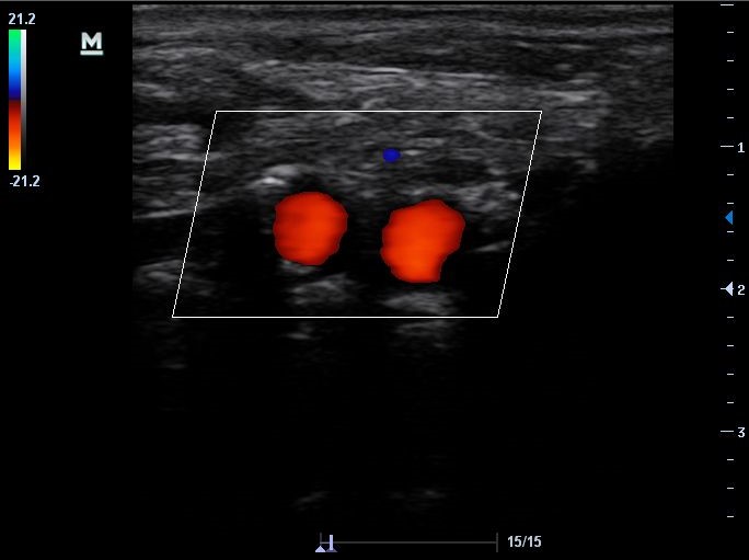 Sonogram of carotid artery