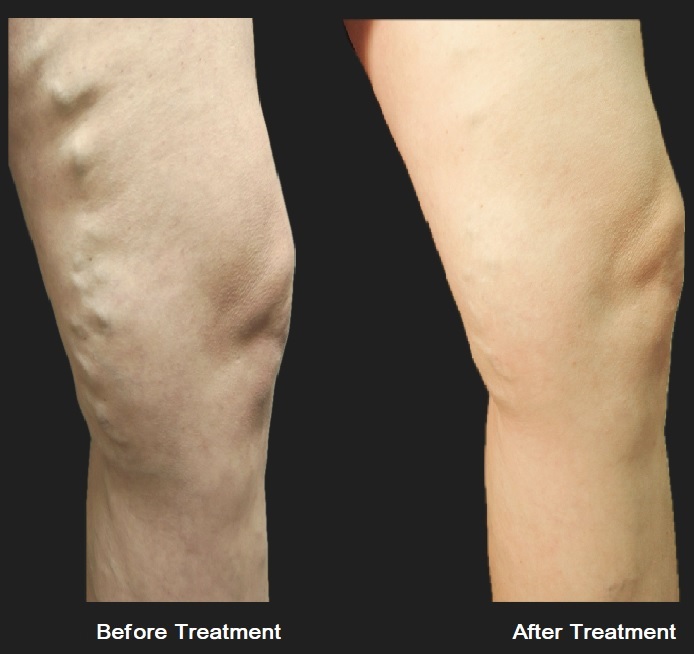 Comparison of leg vein treatment