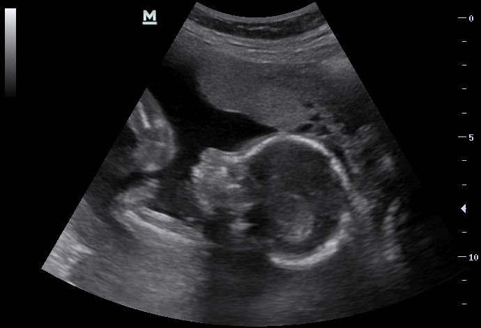 Sonogram of fetus