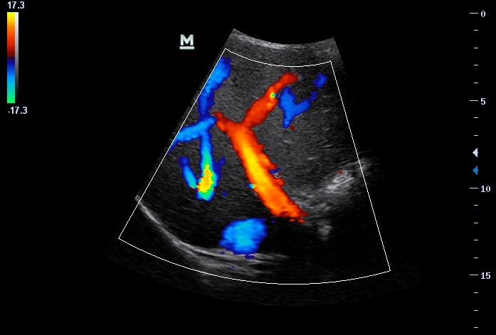 Sonogram of main portal vein
