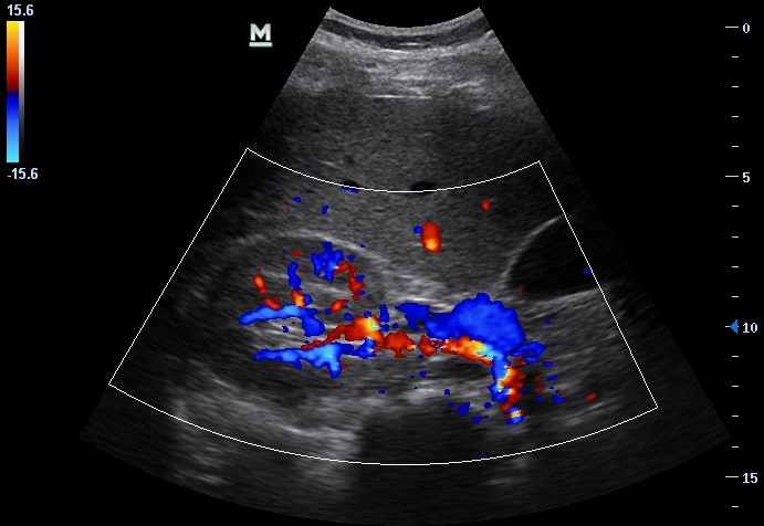 Sonogram of renal arteries