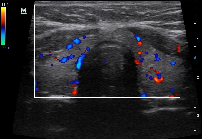 Sonogram of thyroid